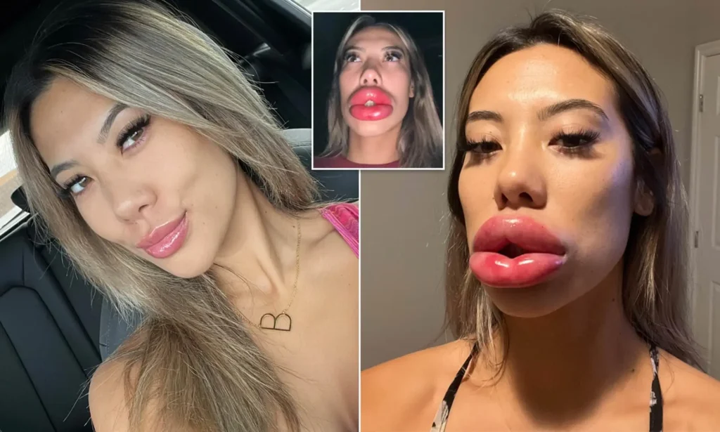 Unnatural Shape or Contour Overfilled Lips