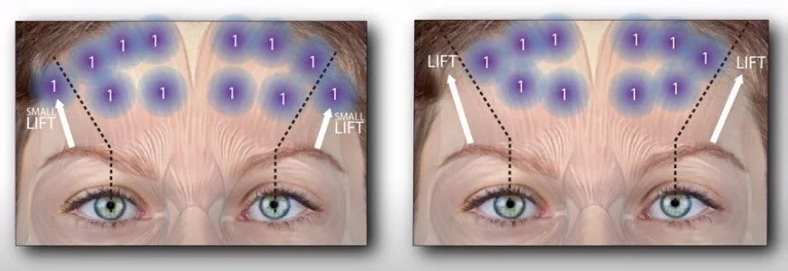 Injection Technique for Lateral Brow Lift