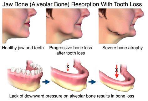 jaw bone exposed through gum