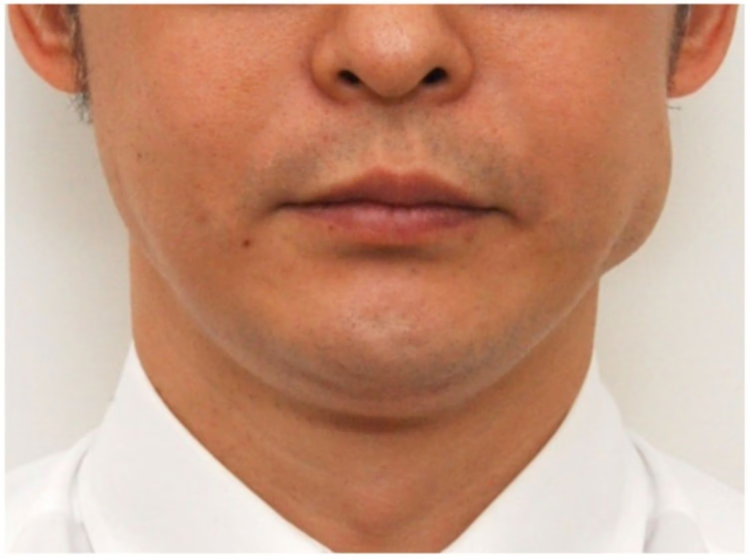 jaw filler injection complications