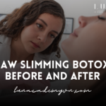 Jaw Slimming Botox Before and After