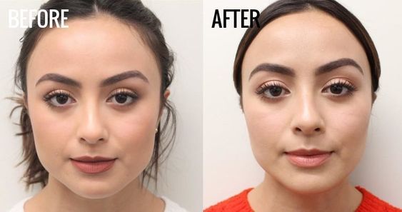 Jaw Slimming Botox Before and After Results