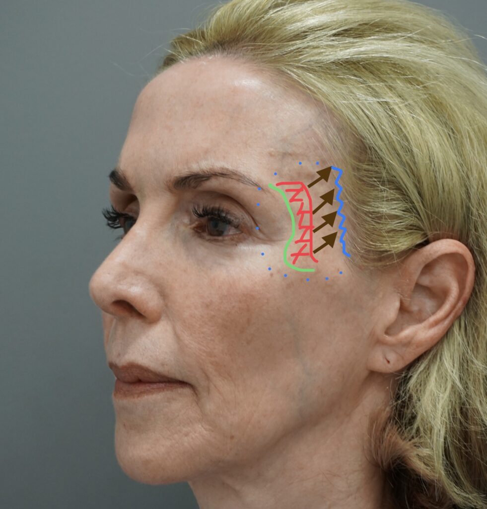 Lateral Brow Lift