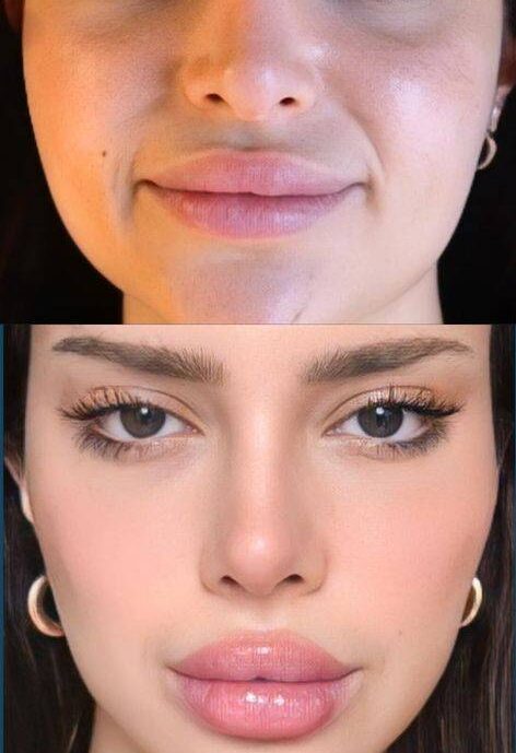 lip augmentation edinburgh