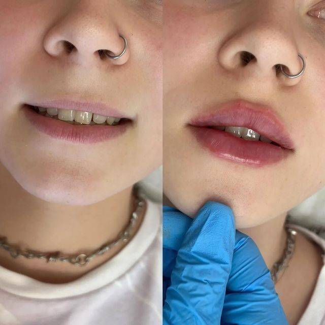 lip augmentation edinburgh