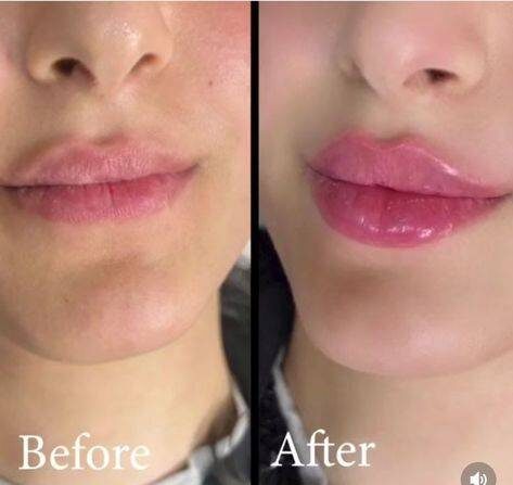 lip augmentation with juvederm