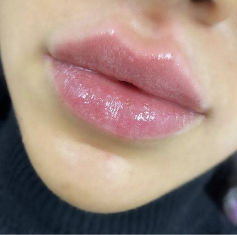 lip augmentation with juvederm