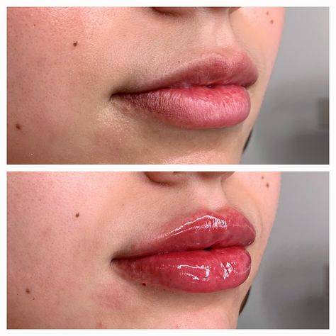 lip augmentation with juvederm