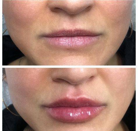 lip augmentation with juvederm