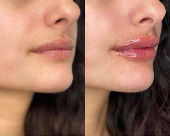 lip augmentation with juvederm