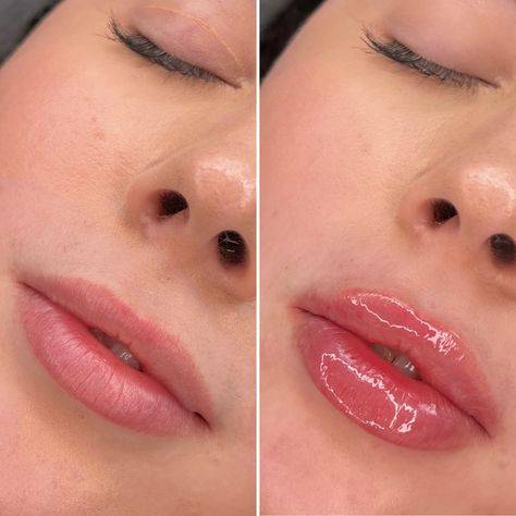 lip augmentation with juvederm