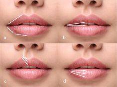 lip filler injection techniques