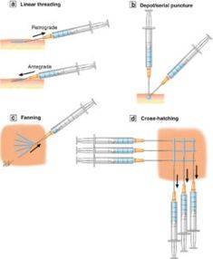 lip filler injection techniques