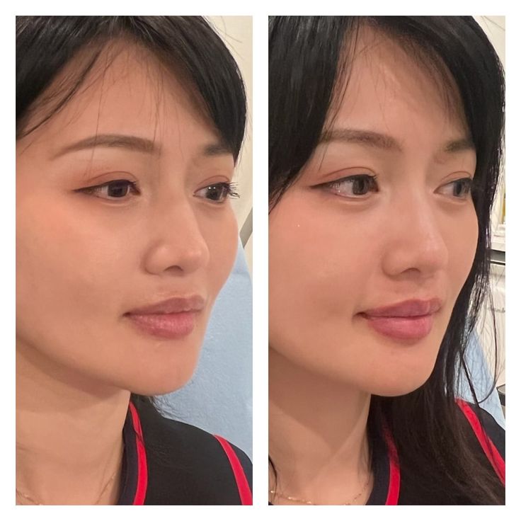 Lip filler quality before and after