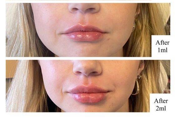 lip filler straw