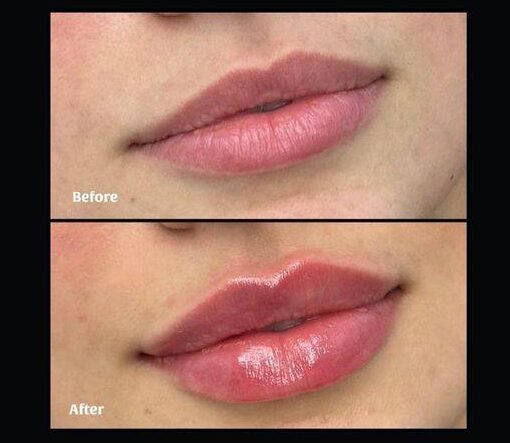 lip filler uneven