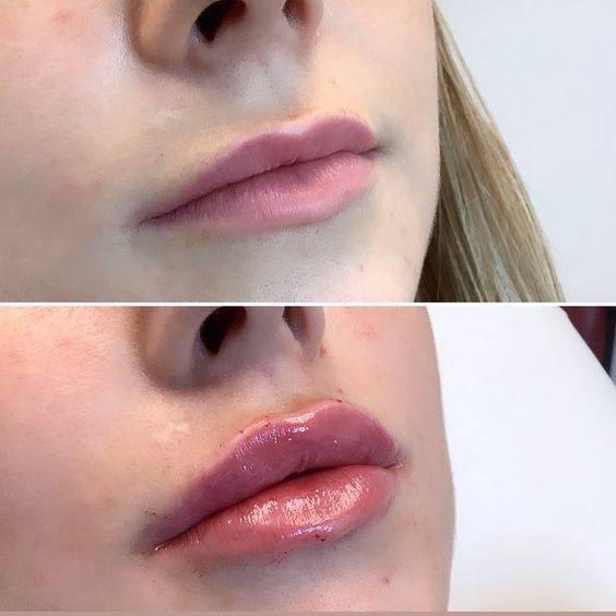 lip filler uneven