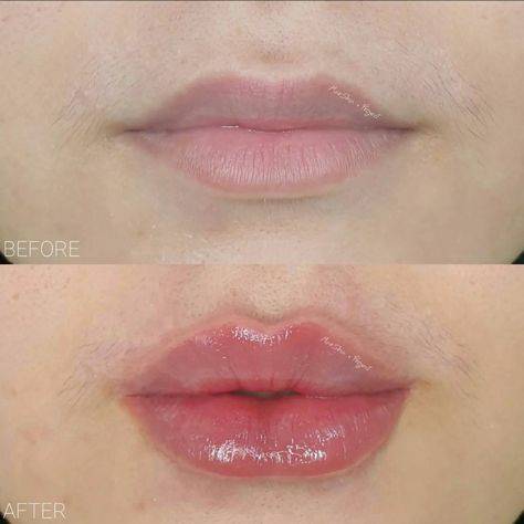 lip filler uneven