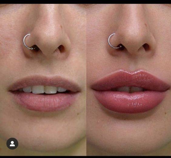 lip filler uneven