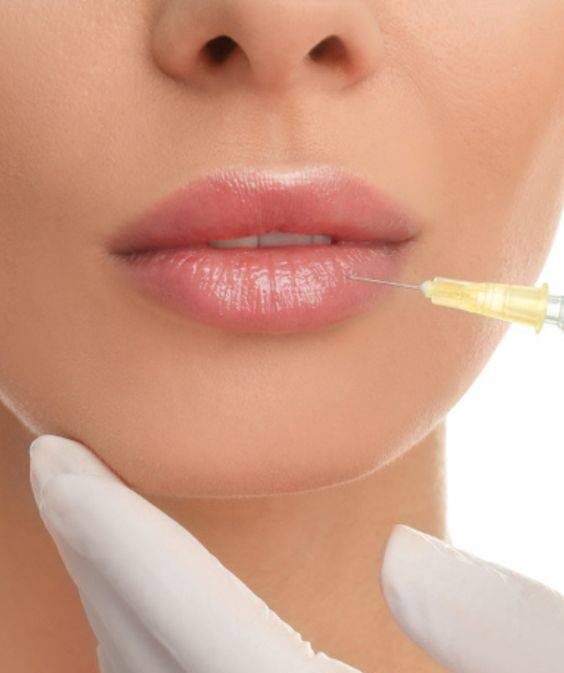 Lip Fillers