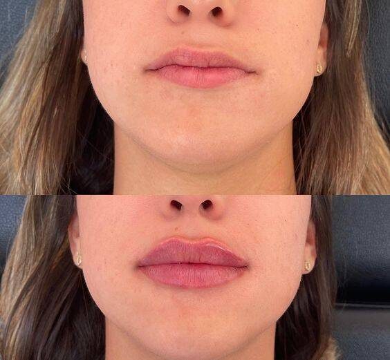 lip fillers newcastle