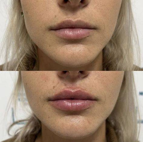 lip fillers newcastle