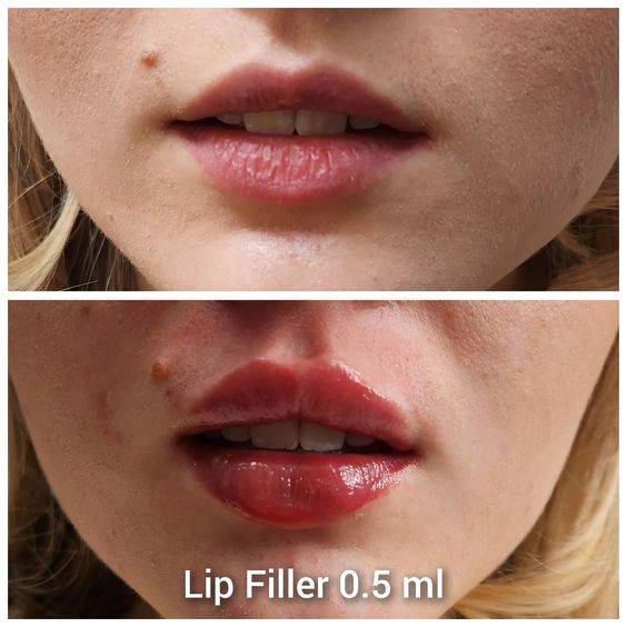 lip fillers newcastle