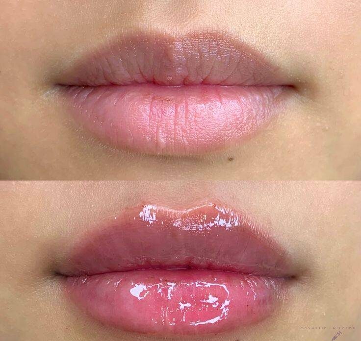 lip fillers newcastle