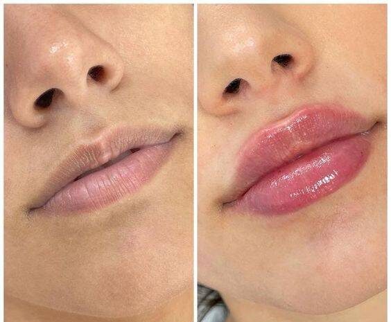 lip fillers newcastle