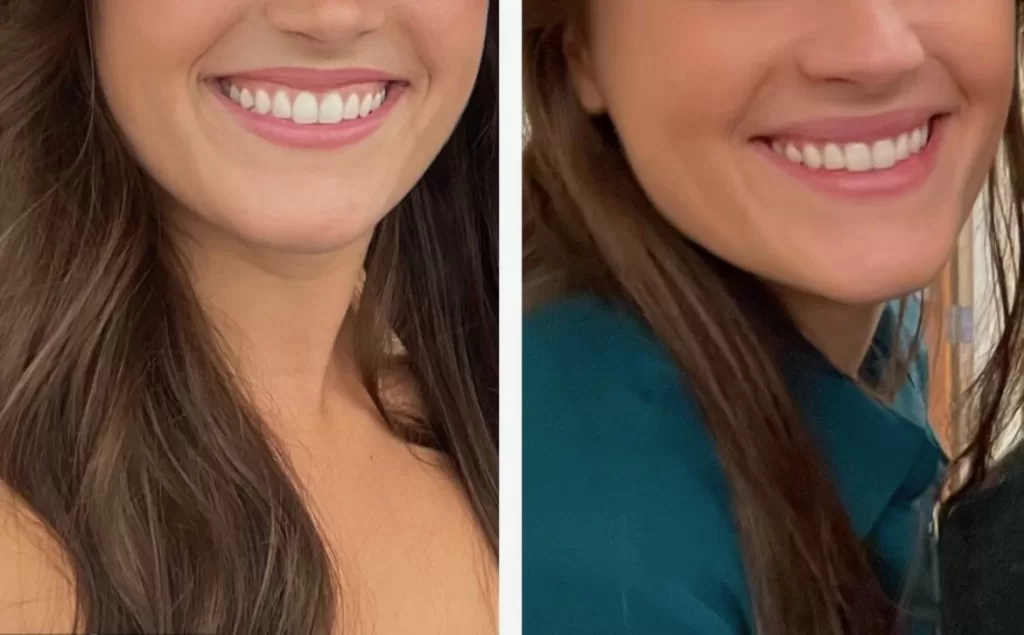 Lip Flip Before and After Thin Lips: Real Results