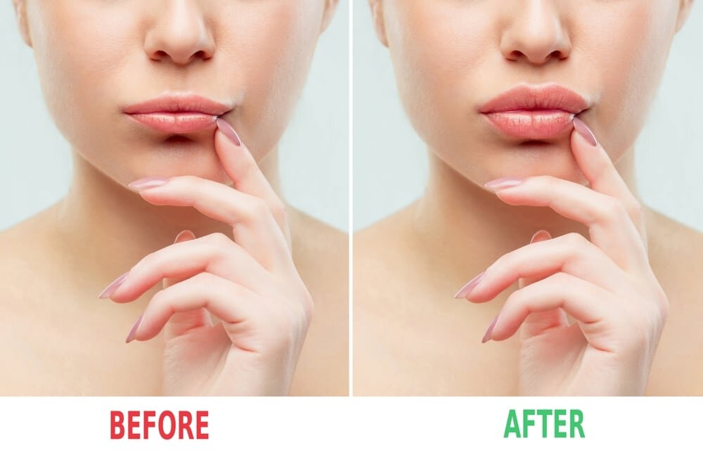 Lip Flip Suitability for Thin Lips