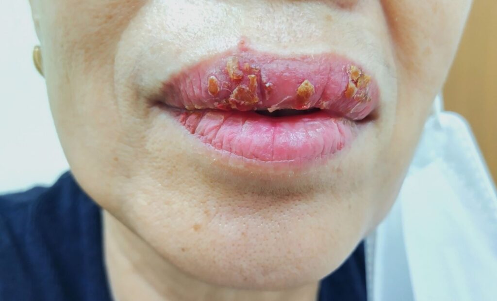 lip infection after filler injection