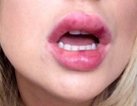 lip injection gone wrong