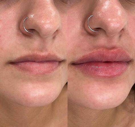 lip injection recovery