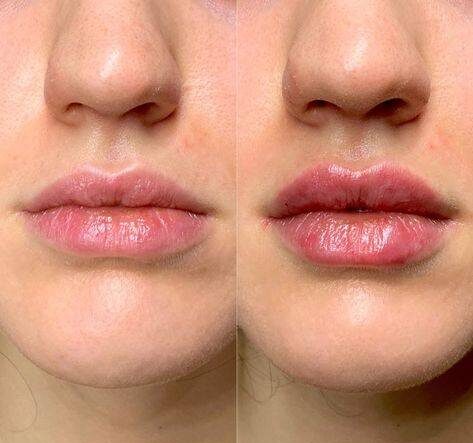 lip injections edinburgh