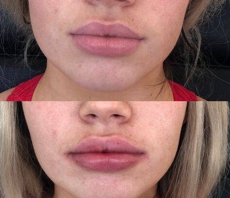 lip injections edinburgh