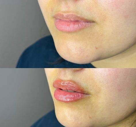 lip injections edinburgh