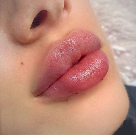 lip injections on big lips