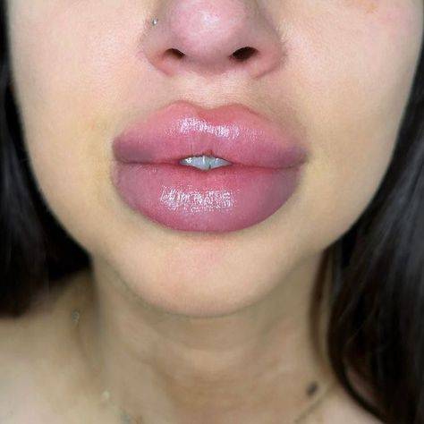 lip injections on big lips