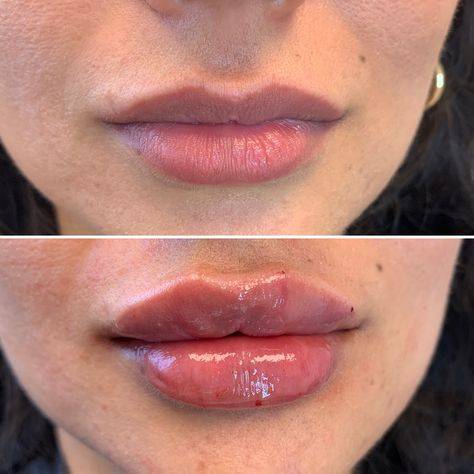 lip injections on big lips