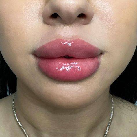 lip injections on big lips