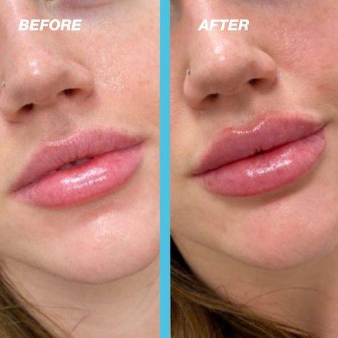 lip injections on big lips