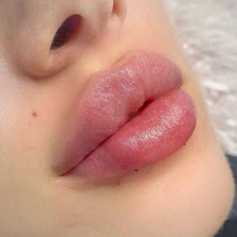 lip injections on big lips