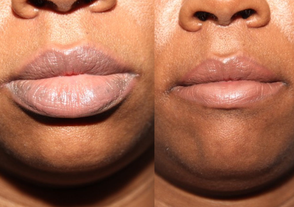 Lip Reduction Surgery