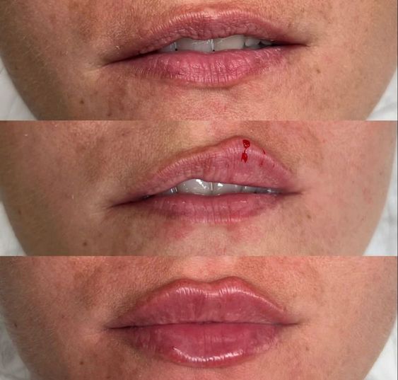 Lips are crooked due to improper filler injection technique.