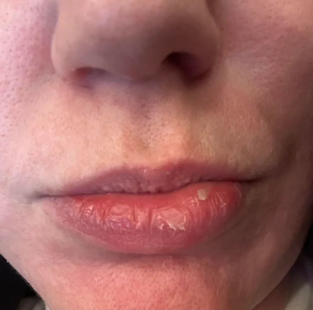 Lips Peel After Filler