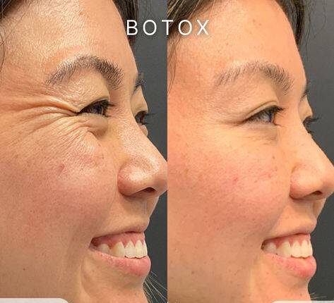 masseter botox gone wrong