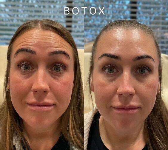 masseter botox gone wrong