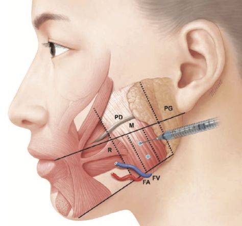 masseter muscle botox