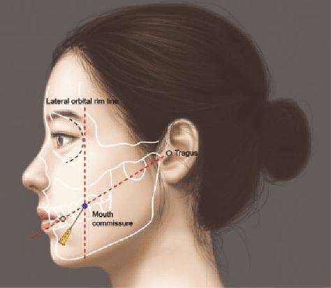 masseter muscle botox